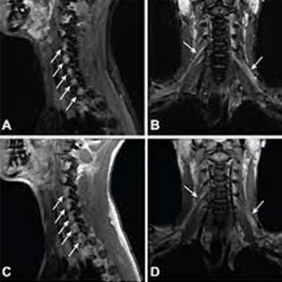 MRI Screening Brachial Plexus